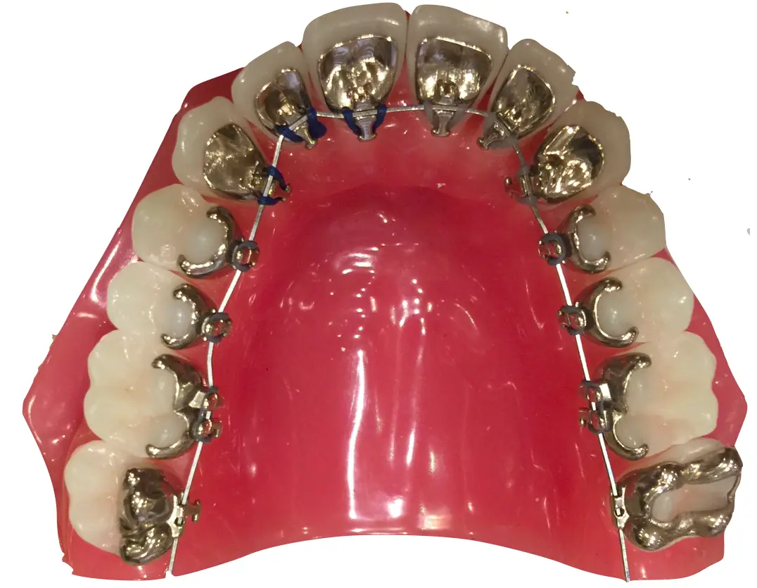 Lingual Orthodontics