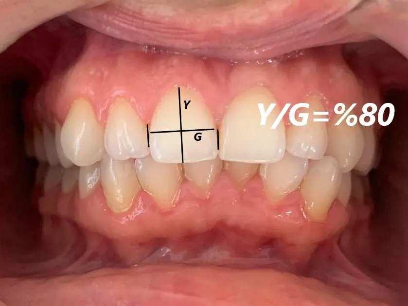 Dental Aesthetics