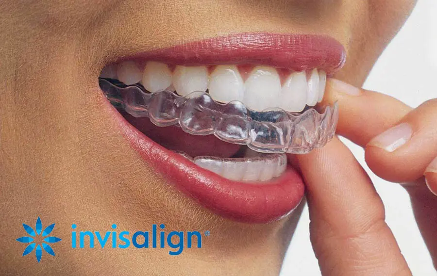 Orthodontics with Transparent Plates