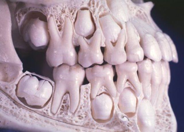 Early Age Orthodontics and Jaw Orthopedics