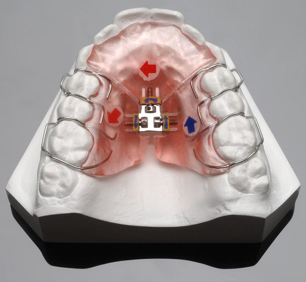 Early Age Orthodontics and Jaw Orthopedics