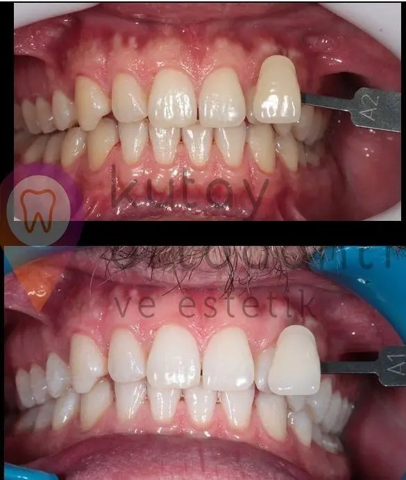 Teeth Whitning