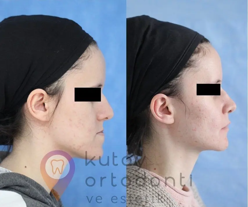 Orthognathic Surgery