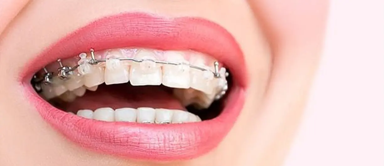 Her Yaşta Ortodontik Tedavi Mümkün Mü