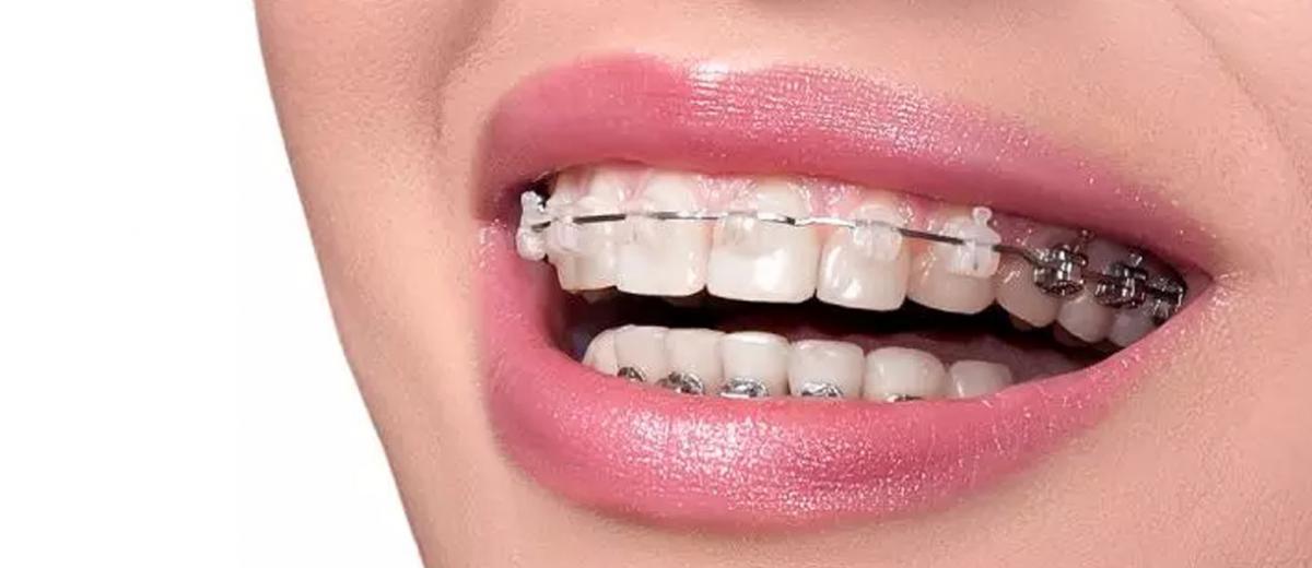 Ortodontik Tedavide Kullanılan Lastikler