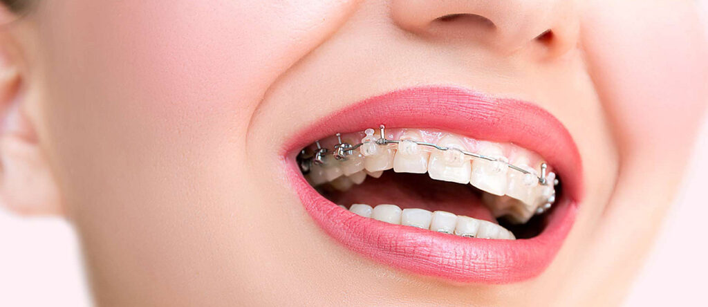 Ortodontik Tedavinin Bilinmeyen Faydaları