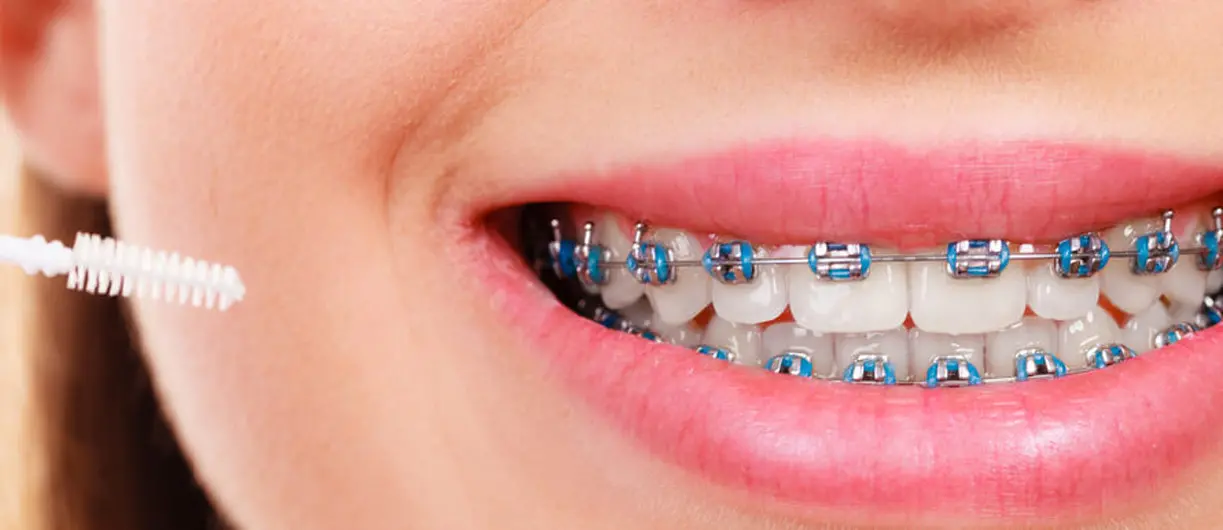 renkli diş telleri nasıl takılır