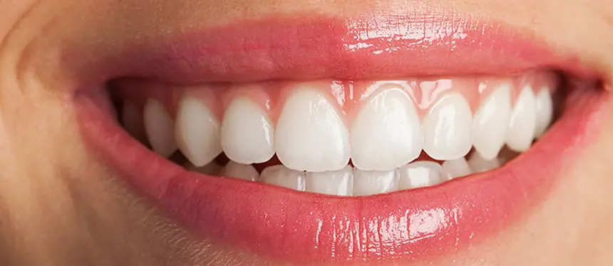 Gummy Smile veya Diş Eti Gülümsemesi Nedir