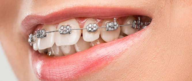 Diş Teli Tedavisi Nasıl Yapılır?