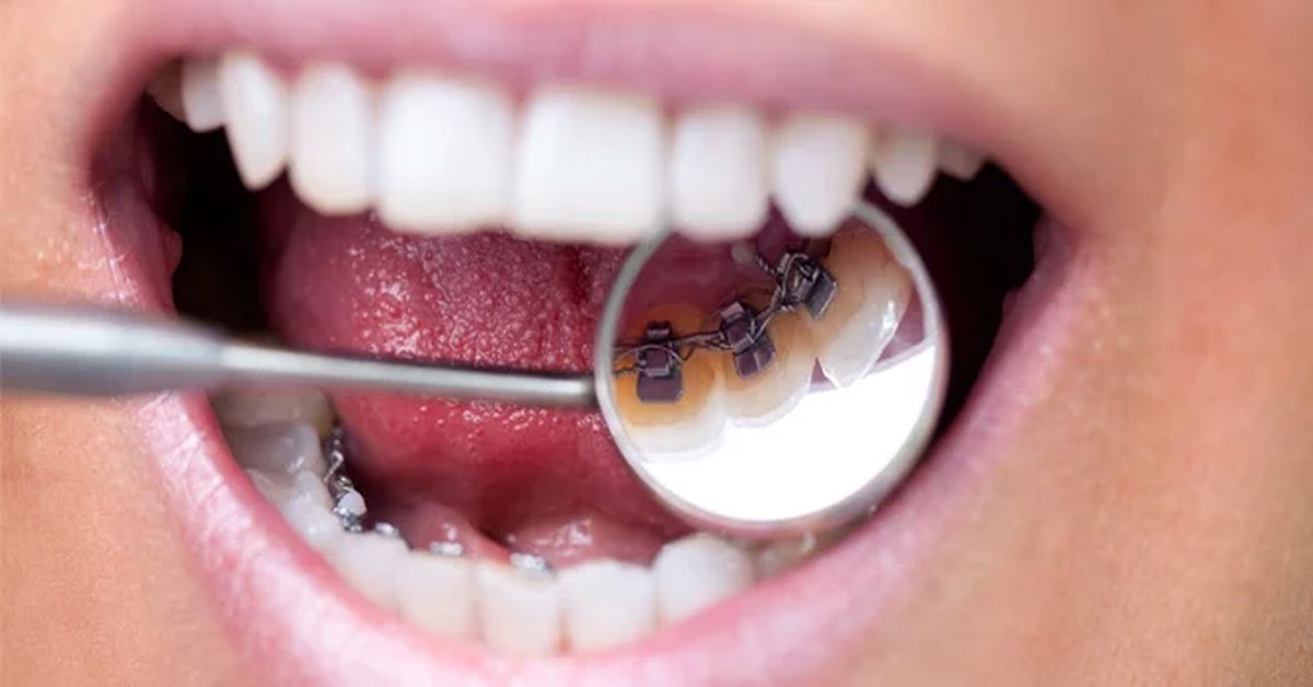 Lingual Ortodonti Tedavisi