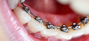 Lingual ortodonti ters diş teli tedavisi
