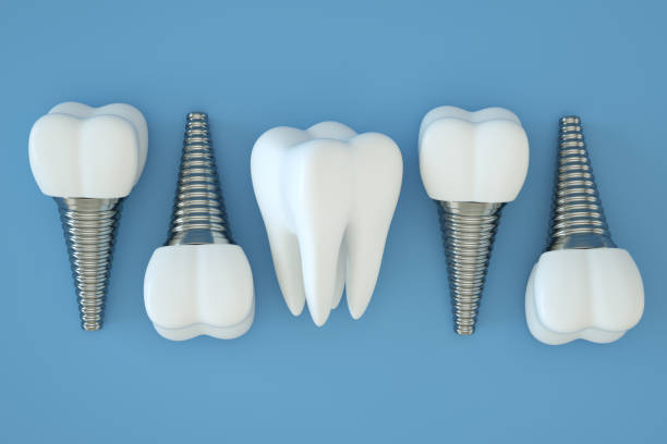Dental İmplant Teknolojileri