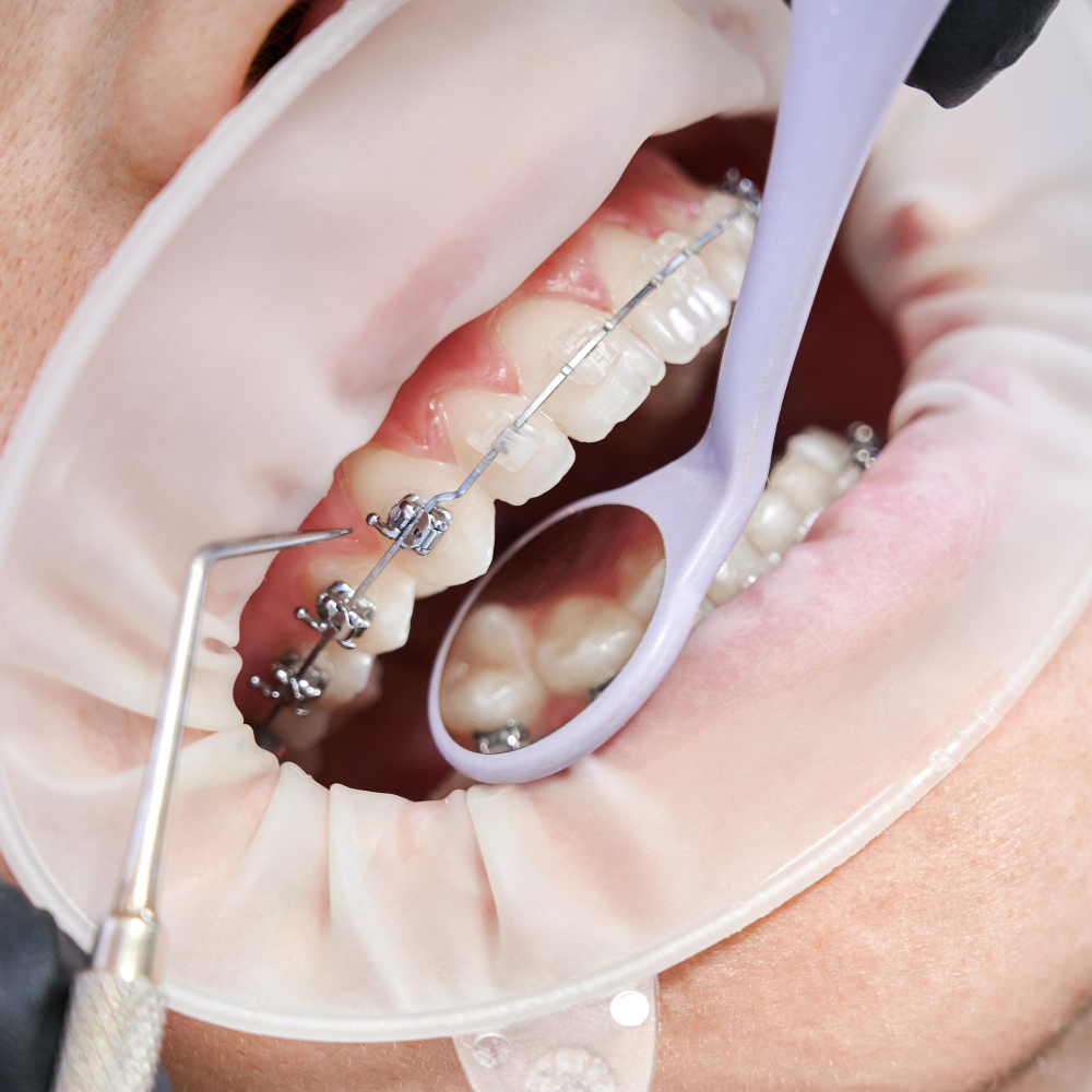 Çapraşık Diş Tedavisi