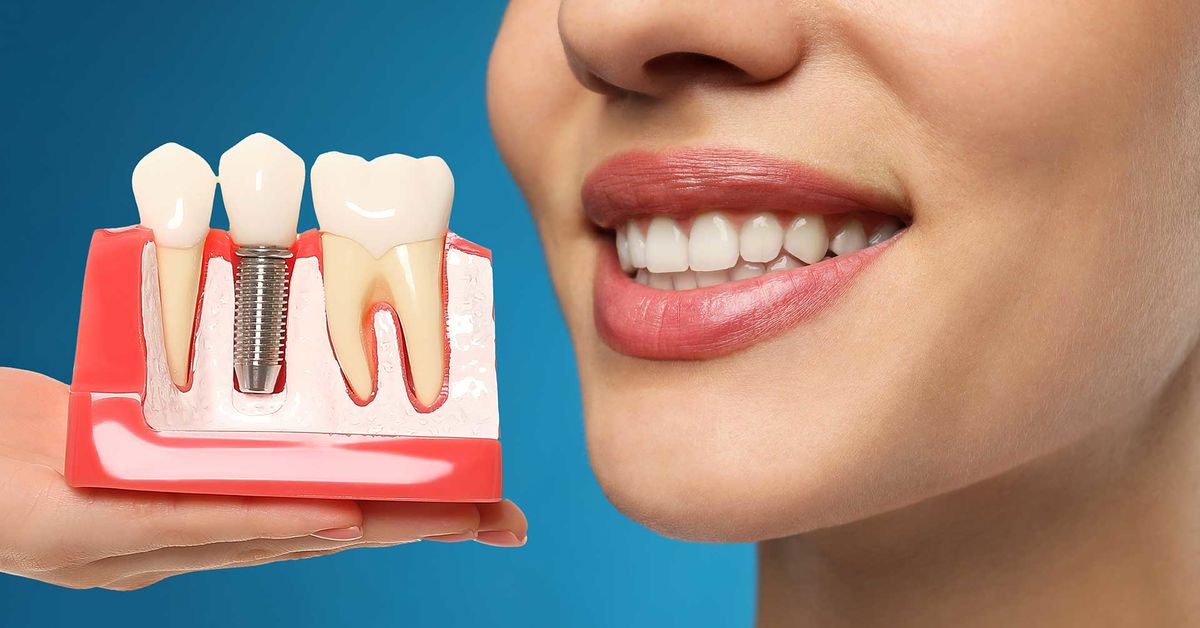 Dental İmplant Tedavisi Nedir?