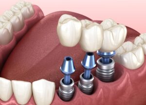 Dental İmplant Tedavisi Nedir?