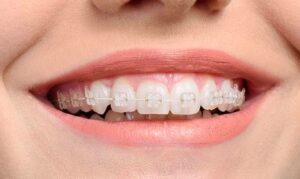 Şeffaf Diş Teli Tedavisi