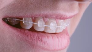 Şeffaf Diş Teli Tedavisi