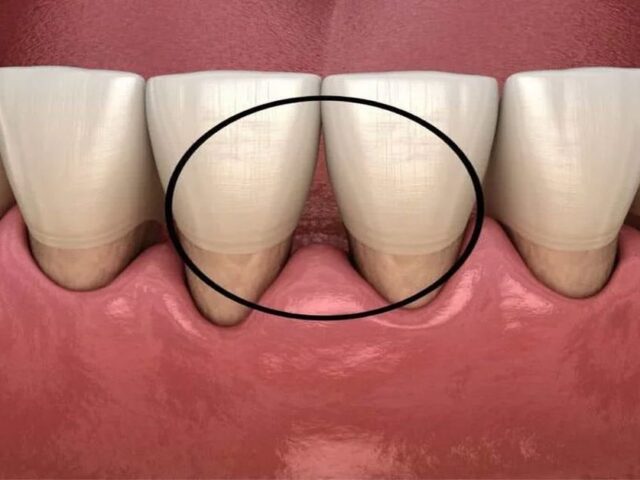 Diş Eti Seviyeleme Fiyatları