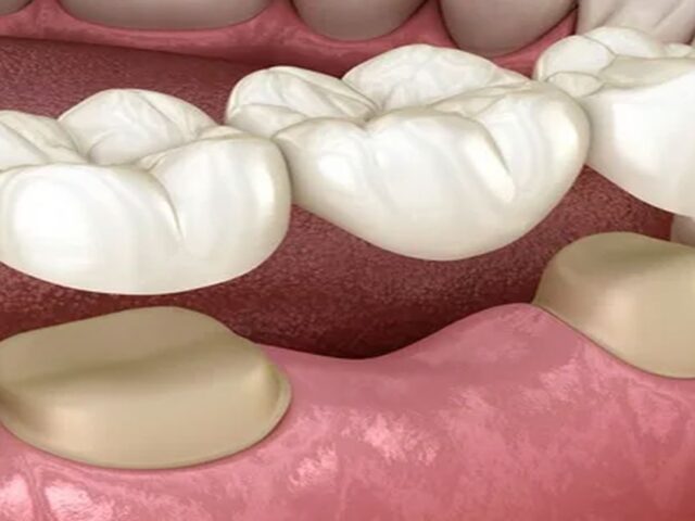 Köprü Protezi Nasıl Yapılır?