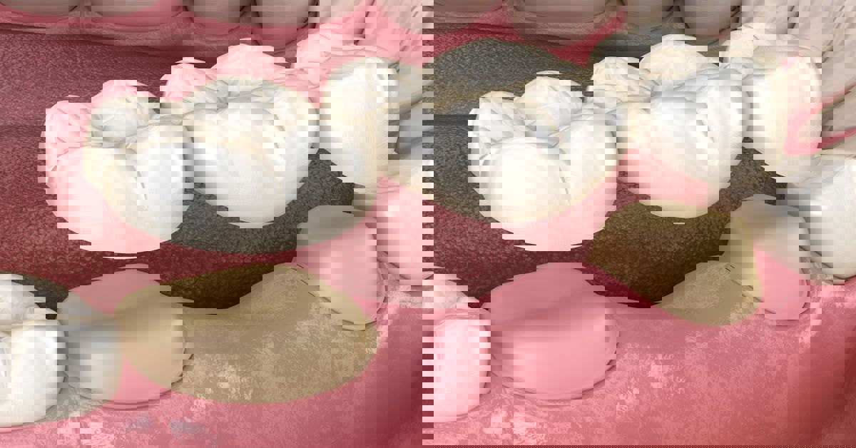 Köprü Protezi Nedir?