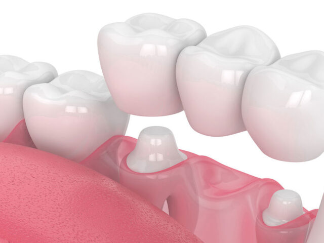 Köprü Protezi Nedir?